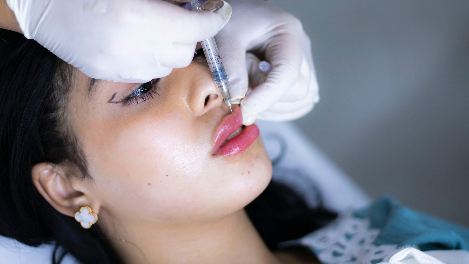 Lip Contouring and Fill Featured Image